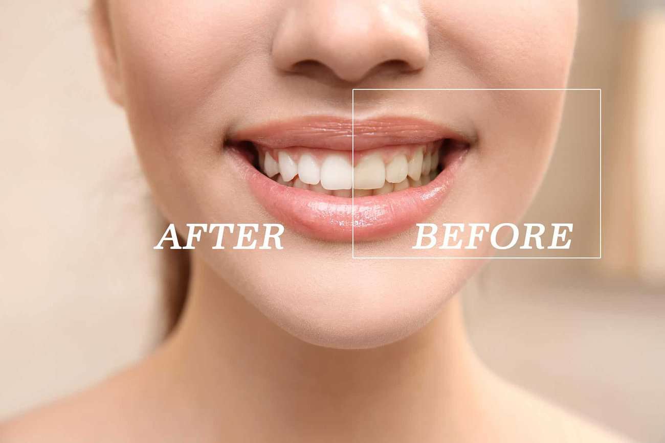 What Are the Most Effective Natural Teeth Whitening Methods You Can Try Gosport?