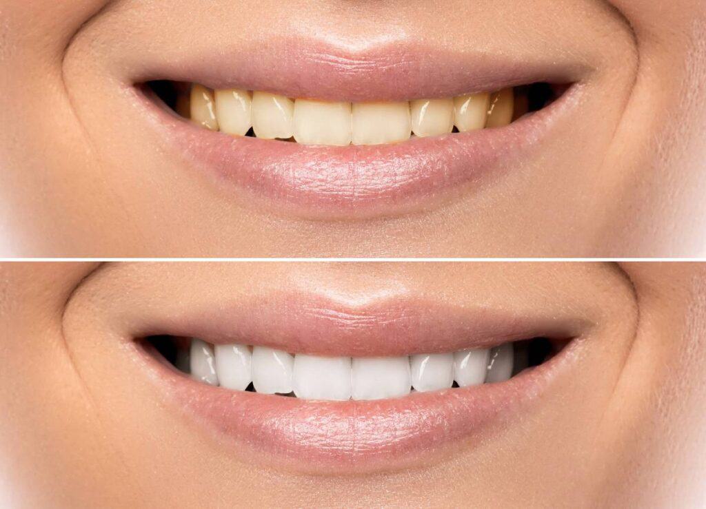 How Can You Protect Your White Smile as a Coffee Lover Gosport?