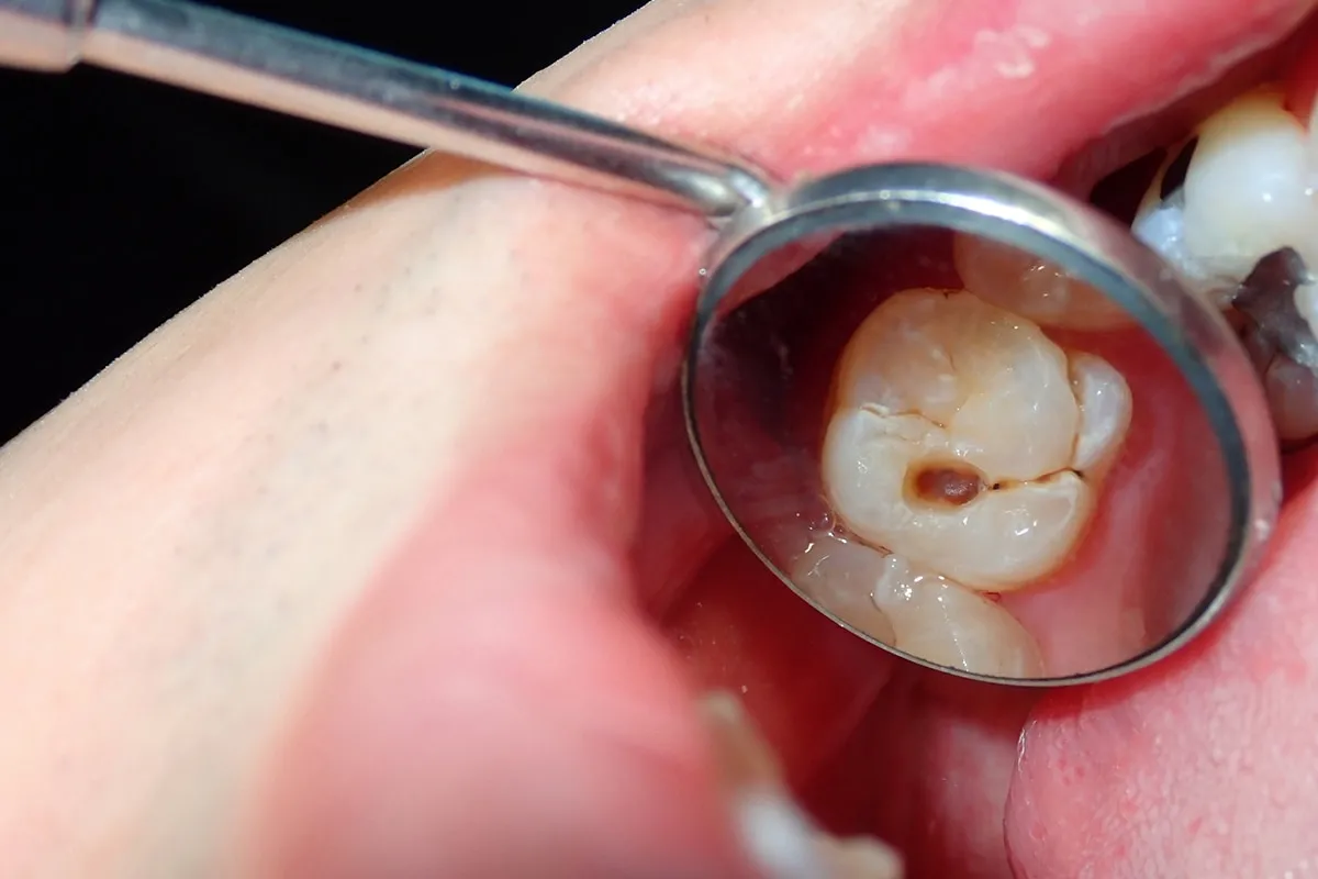 Why Do Teeth Crack? Common Causes to Know Gosport