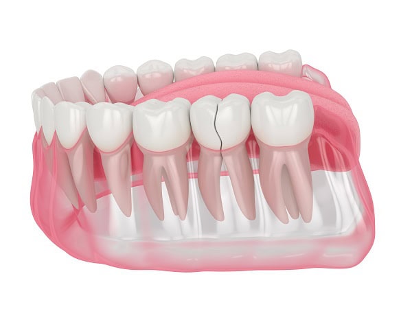 How Can You Manage Pain and Discomfort After a Root Canal Gosport?