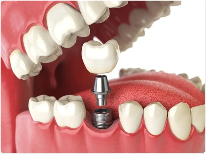 How Do I Decide Which Tooth Replacement Is Right for Me Gosport?