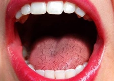 Common Causes of Dry Mouth (Xerostomia) Gosport
