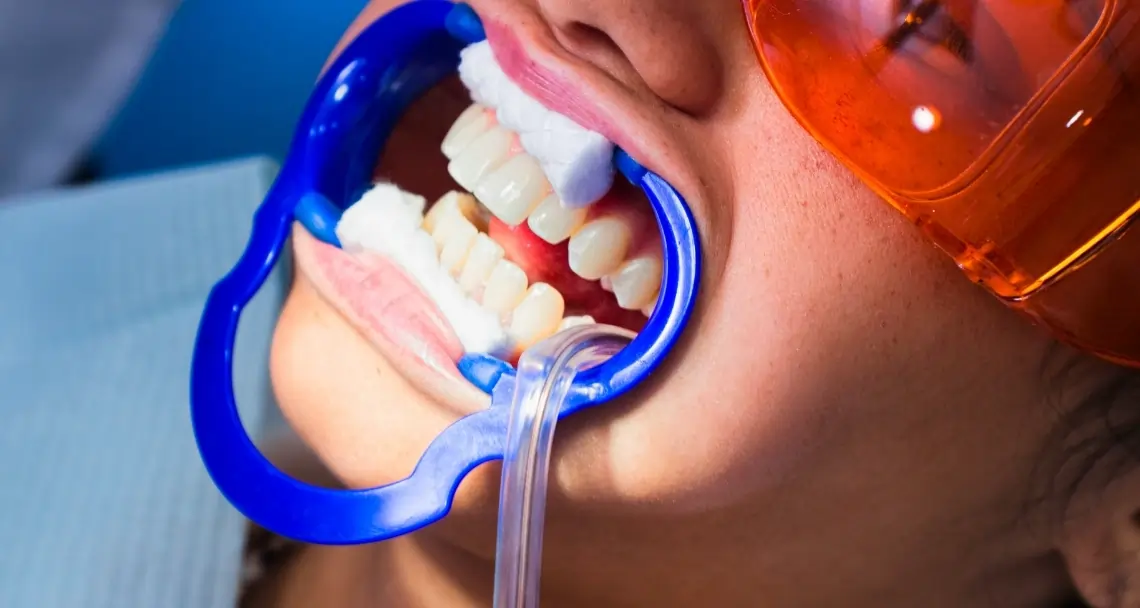 What Side Effects Can You Experience After Laser Teeth Whitening Gosport?