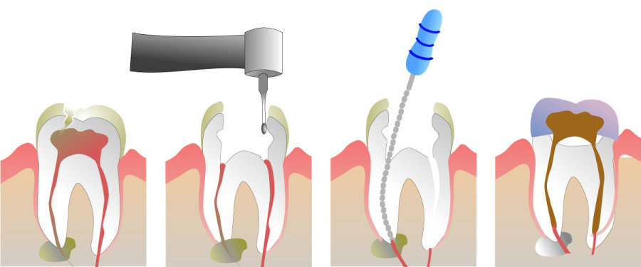 How Do You Properly Care for Your Teeth After a Root Canal Gosport