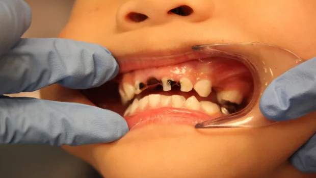 Which Foods and Drinks Cause the Most Damage to Young Smiles Gosport?
