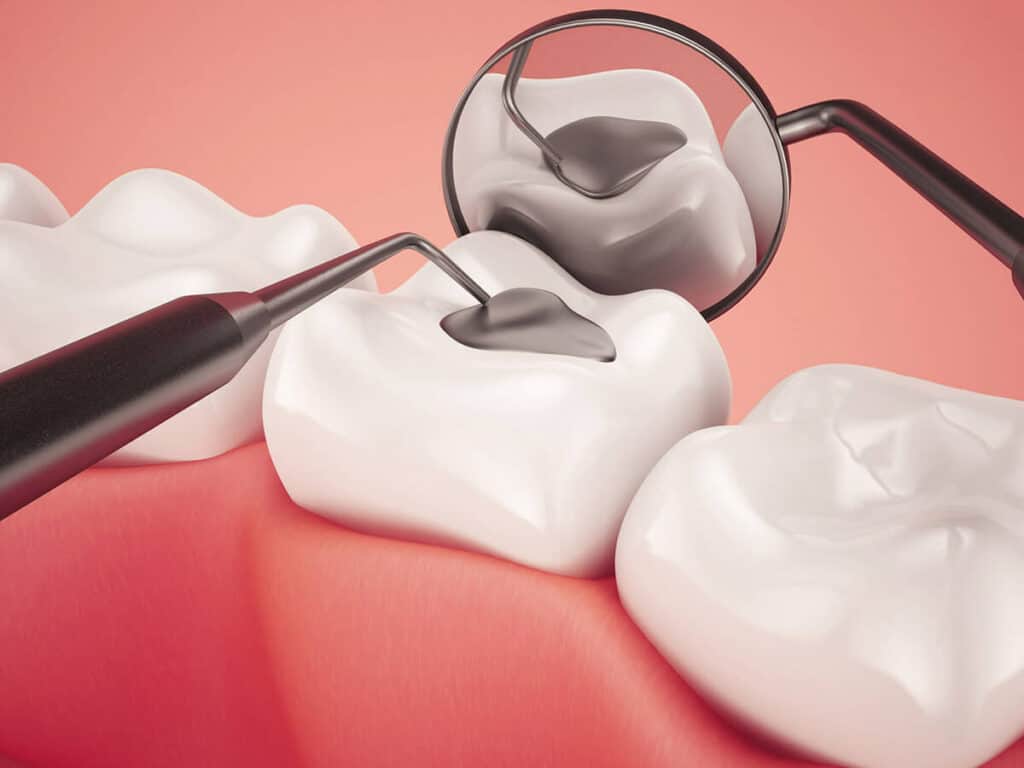 Fighting Cavities and Plaque Buildup Gosport
