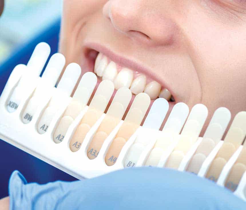 How Much Does One Laser Teeth Whitening Session Cost Gosport?