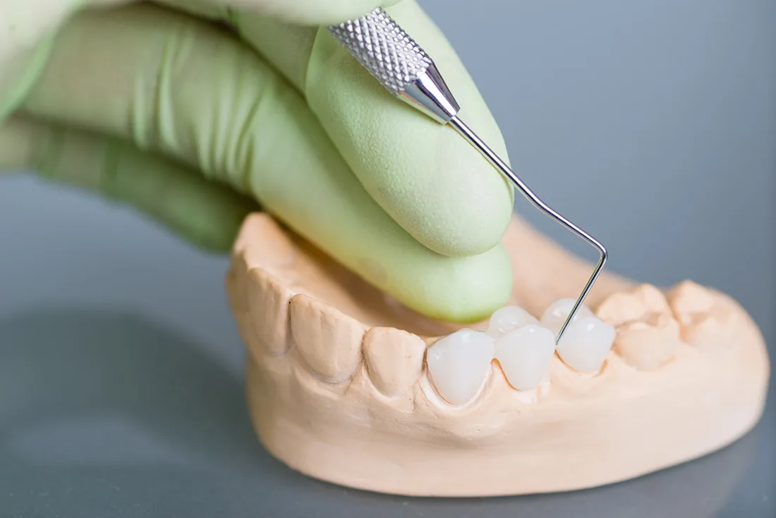 What Are the Different Types of Dental Crowns Available Gosport?