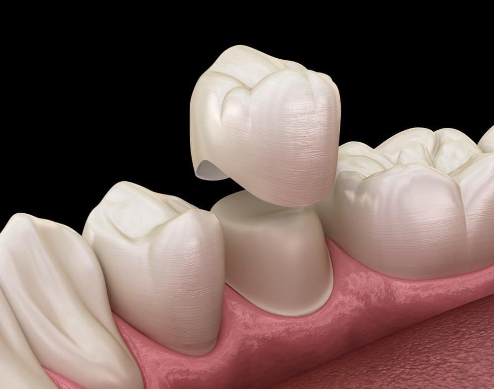 How Can You Prevent Common Dental Crown Problems Gosport?