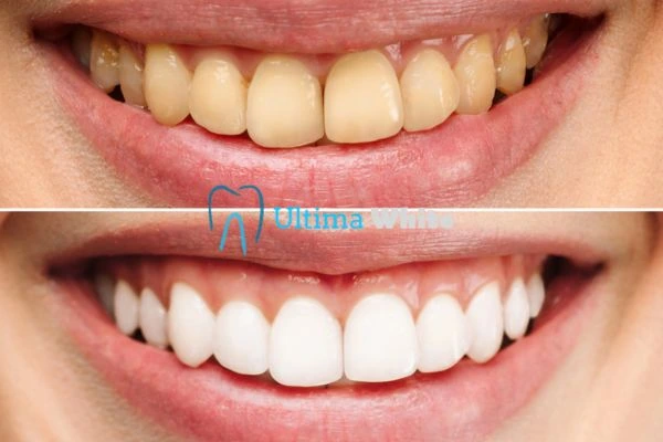 Why Might Multiple Whitening Sessions Be Necessary Gosport?