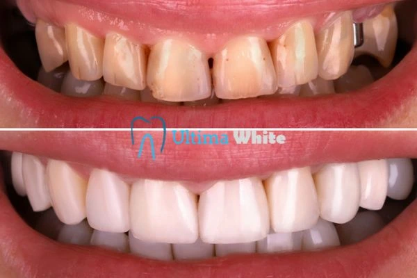 What Makes Instant Teeth Whitening Treatments So Popular Gosport?
