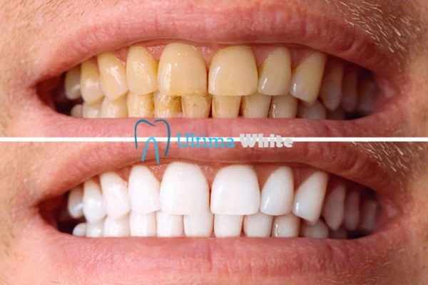 Stained Teeth and Persistent Bad Breath Gosport